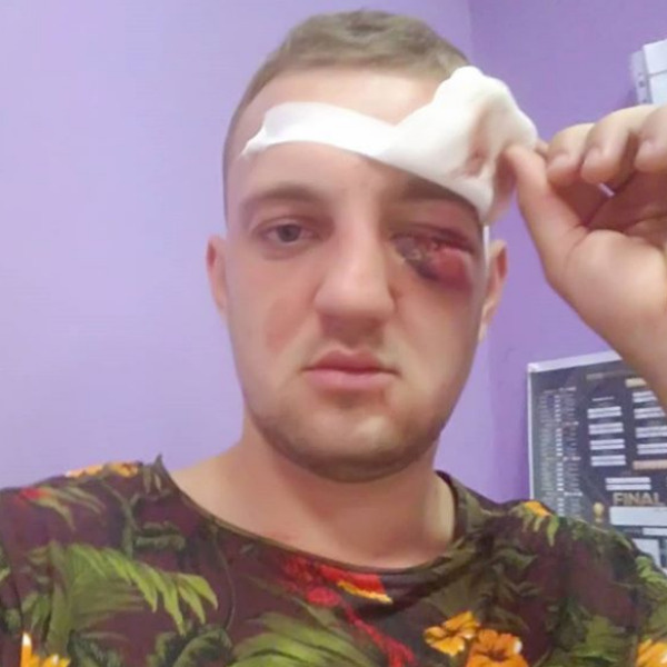 Евгений поспешил показать, какое увечье нанес ему Роман Евгений поспешил показать, какое увечье нанес ему Роман