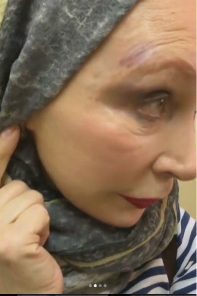 Татьяна Васильева показала гематомы на голове Татьяна Васильева показала гематомы на голове
