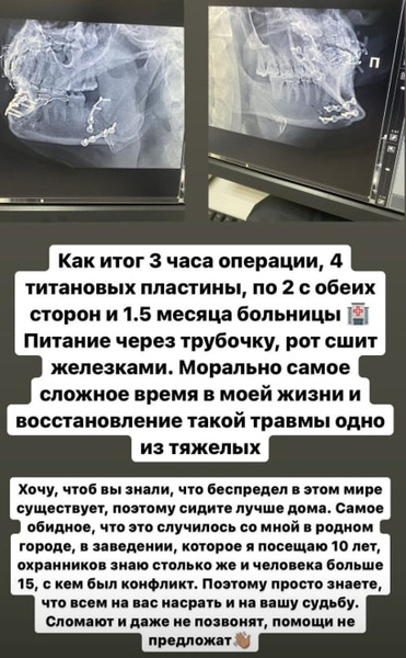 Новости: «Рот сшит железками»: звезду «ДОМа-2» Захара Саленко изувечили в клубе – фото №3