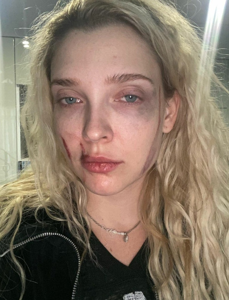 Актриса сняла побои
