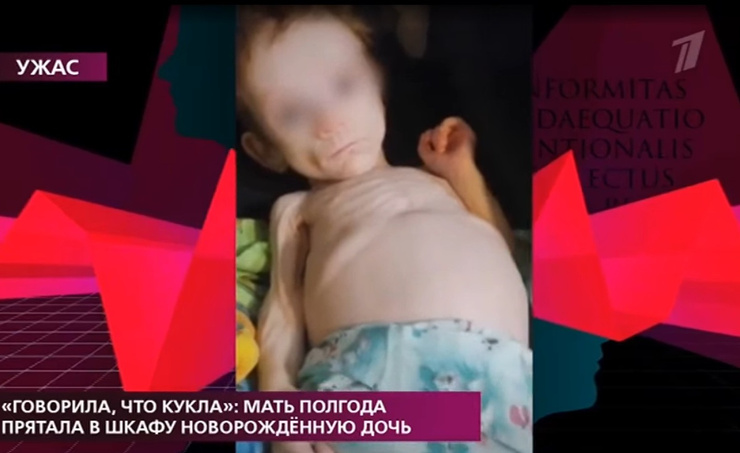 Девочке диагностировали третью стадию истощения