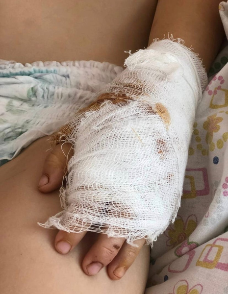 Порваны сухожилия на руках и ногах. Подробности состояния 2-летней девочки, которую истерзала обезьяна