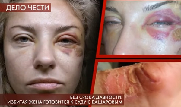 Екатерина зафиксировала побои Екатерина зафиксировала побои
