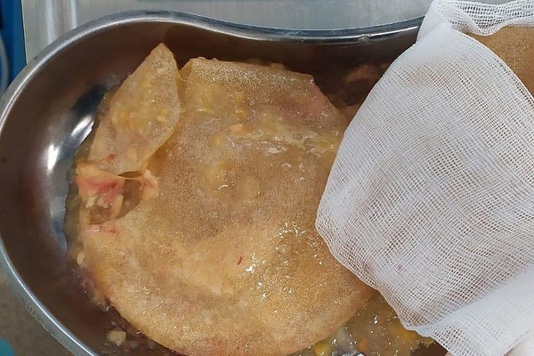 Токсичные материалы из импланта попали в организм телеведущей Токсичные материалы из импланта попали в организм телеведущей