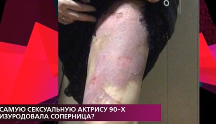Актриса получила травму