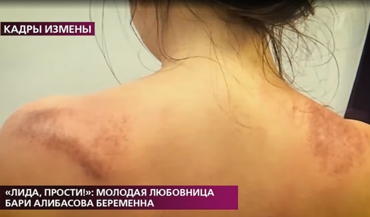 Виктория показала следы ударов